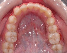 affollamento dentale, estrazioni